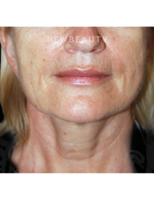 Dr. Roman Rayham - Rejuvenated Look - After