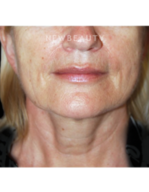 Dr. Roman Rayham - Rejuvenated Look - After