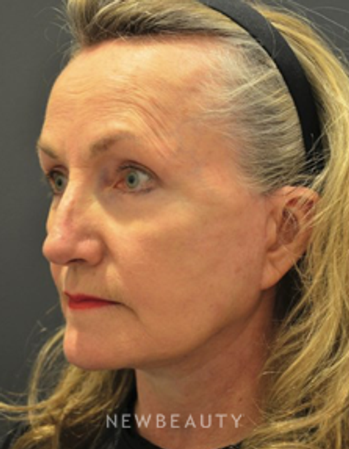 Dr. Aviva Preminger - Facelift - After