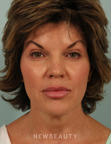 Dr. Kenneth Beer Injectables & Fillers, Restylane - After