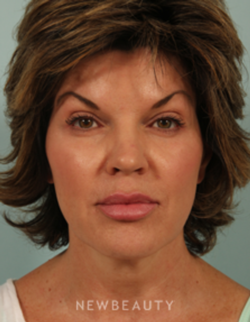Dr. Kenneth Beer Injectables & Fillers, Restylane - After