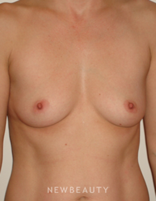 Dr. Michael Horn Breast Augmentation - Before