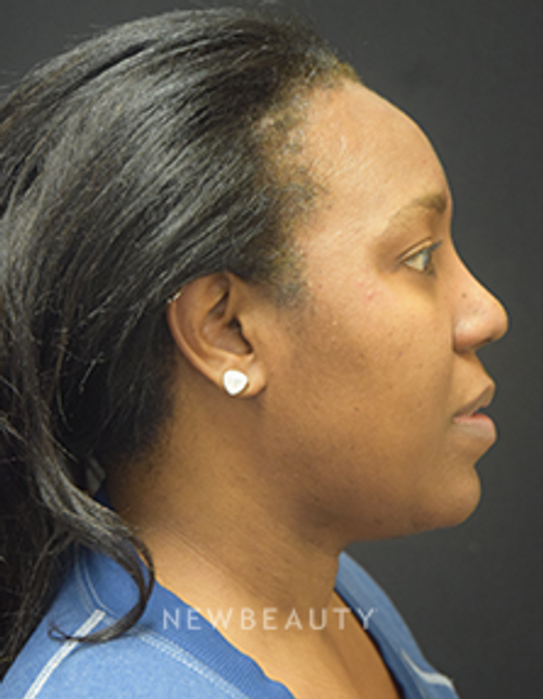 Dr. Jeffrey B. Wise - Lipo & Rhinoplasty - After