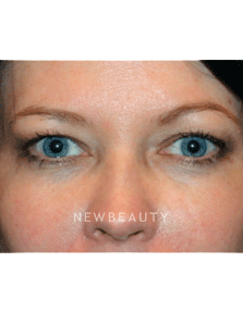 Dr. Kelly Bomer Eyelift - Before