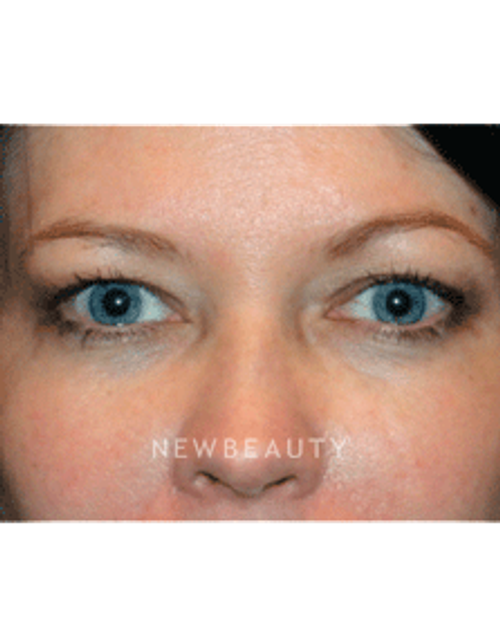 Dr. Kelly Bomer Eyelift - Before