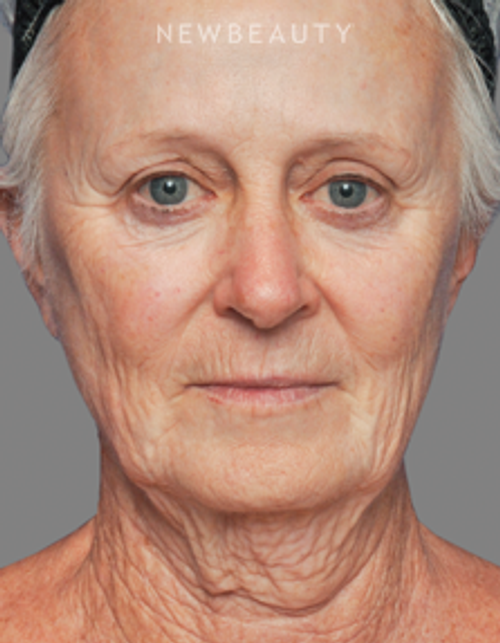 Dr. Alan Durkin - Facelift with Fat Transfer - Before