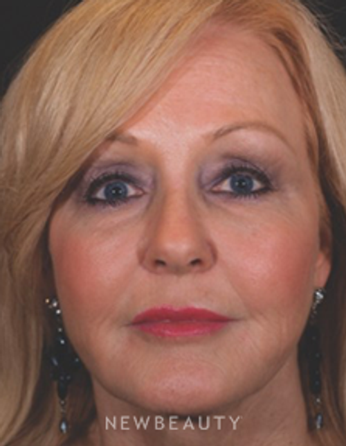 Dr. Kathleen Behr - Facial Rejuvenation - After