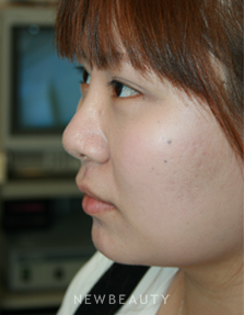 Dr. John Kang - Upper Blepharoplasty & Rhinoplasty - After