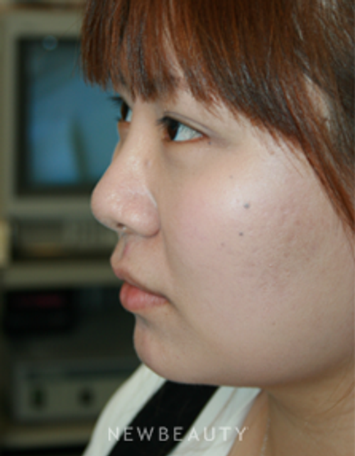 Dr. John Kang - Upper Blepharoplasty & Rhinoplasty - After