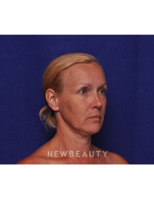 Dr. Alan J. Durkin- Blepharoplasty - Before