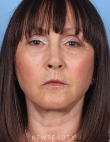 Dr. Kelly Bomer - Facelift - After
