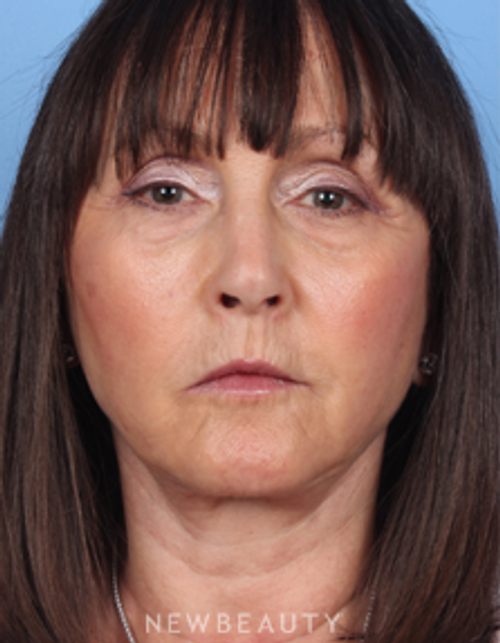 Dr. Kelly Bomer - Facelift - After