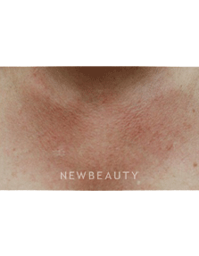 Dr. Beer Laser Treatment - Before