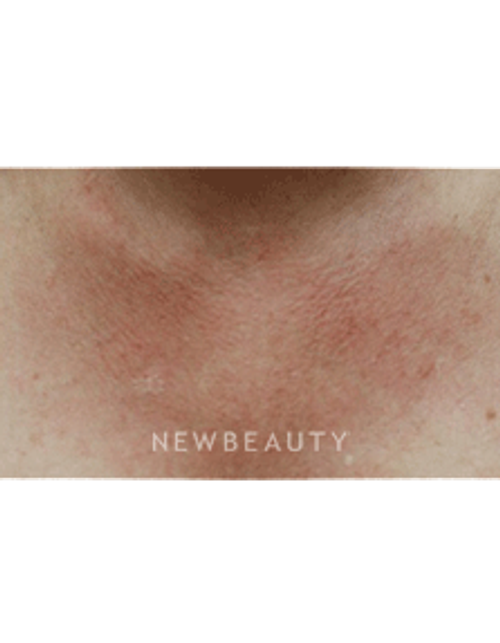 Dr. Beer Laser Treatment - Before