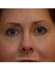 Dr. Janet Allenby - Kybella - After