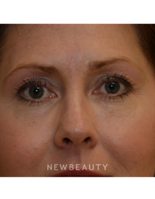 Dr. Janet Allenby - Kybella - After