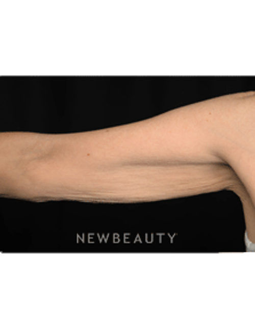 Dr. Hillelson - Skin Tightening - After