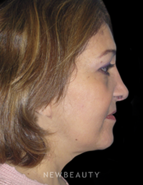 Dr. Elie Levine Facelift, Necklift - After