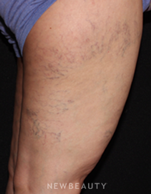 Dr. Gilly Munavalli - Spider Veins - Before