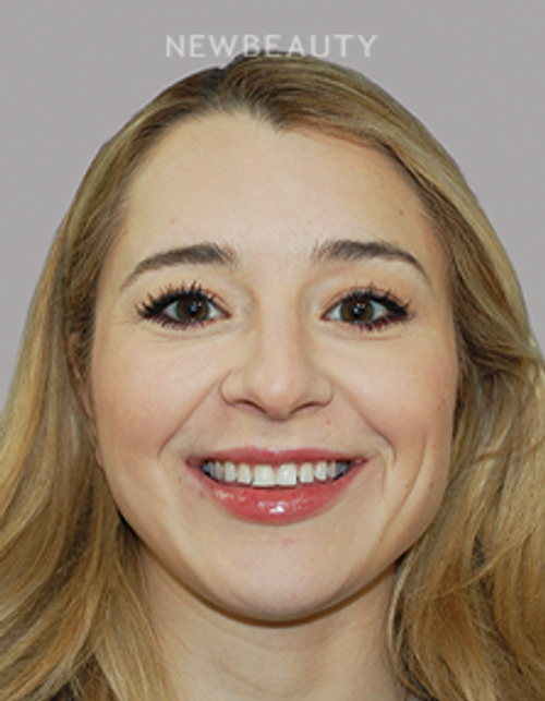 Dr. Salvator La Mastra - Smile Makeover 46109347 - Before