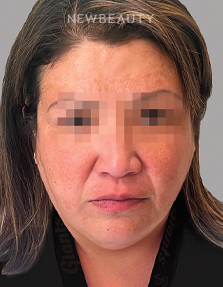 Dr. Anna Chacon - Melasma - 34280278 - After