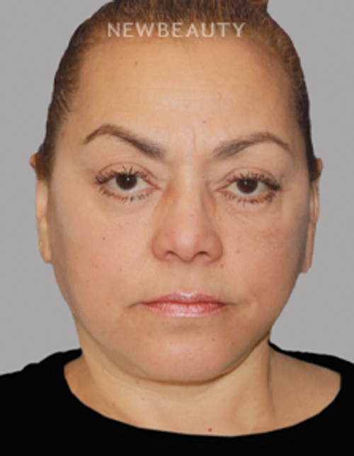 Dr. Konstantin Vasyukevich – Necklift and Facelift – 51896918 - After