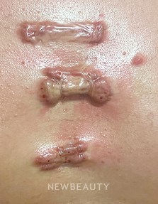 Dr. Anna Chacon – Acne Scarring - 34277144 - After