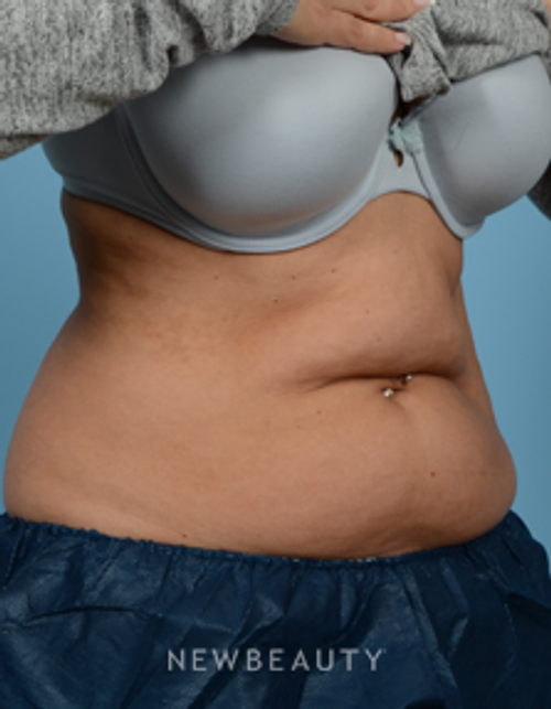 Dr. Jeffrey Wise - CoolSculpting - Before