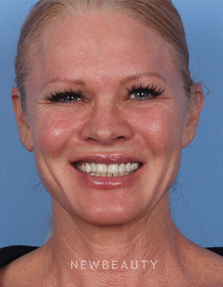 Dr. Kelly Bomer - Botox - After