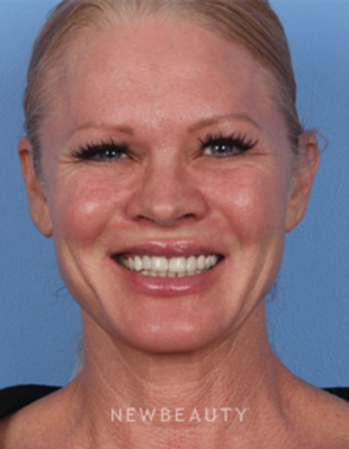 Dr. Kelly Bomer - Botox - After