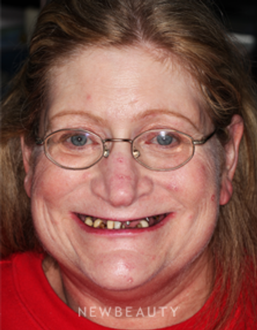 Dr. Neal Patel Smile Makeover, Dental Implants - Before