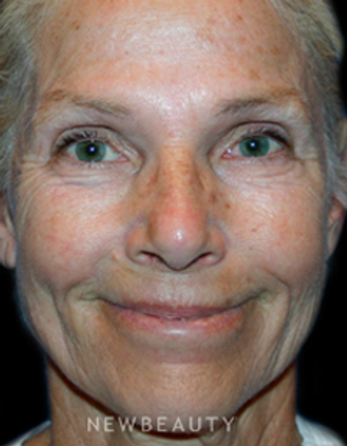 Dr. Kelly Bomer Liquid Facelift - Before