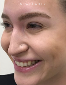 Dr. Julie Russak - Injectables & Fillers - After