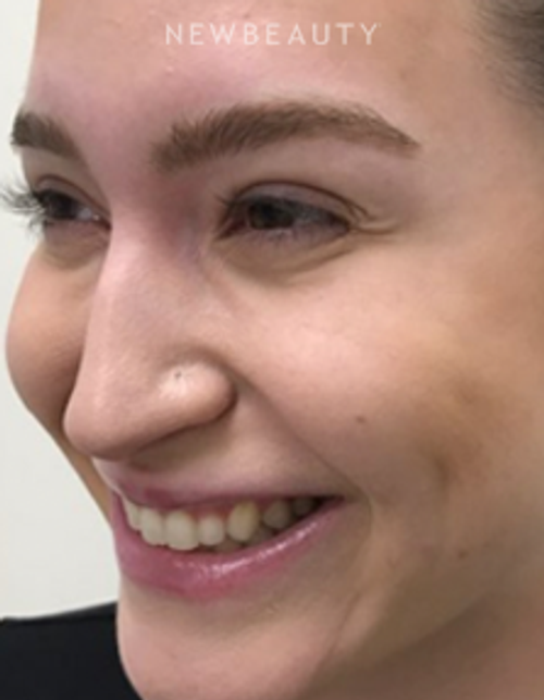 Dr. Julie Russak - Injectables & Fillers - After
