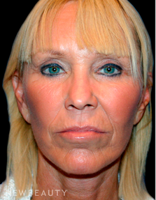 Dr. Kelly Bomer Facelift - After
