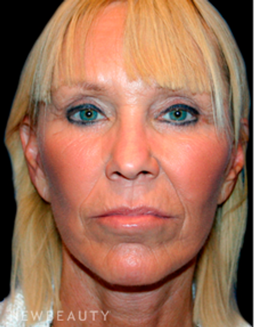 Dr. Kelly Bomer Facelift - After