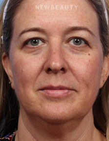 Dr. Kelly Bomer - Upper Blepharoplasty & Liquid Facelift - Before