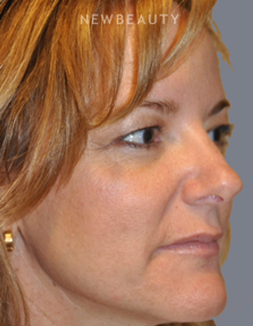 Dr. Bryan W. Gawley - Revision Rhinoplasty - Before