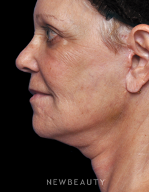 Dr. Alan Durkin - Limited Incision Facelift - After