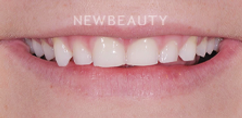 Dr. Salvator La Mastra - Smile Makeover -46106746 - Before