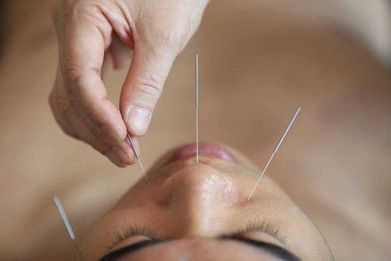 beevenomacupuncture