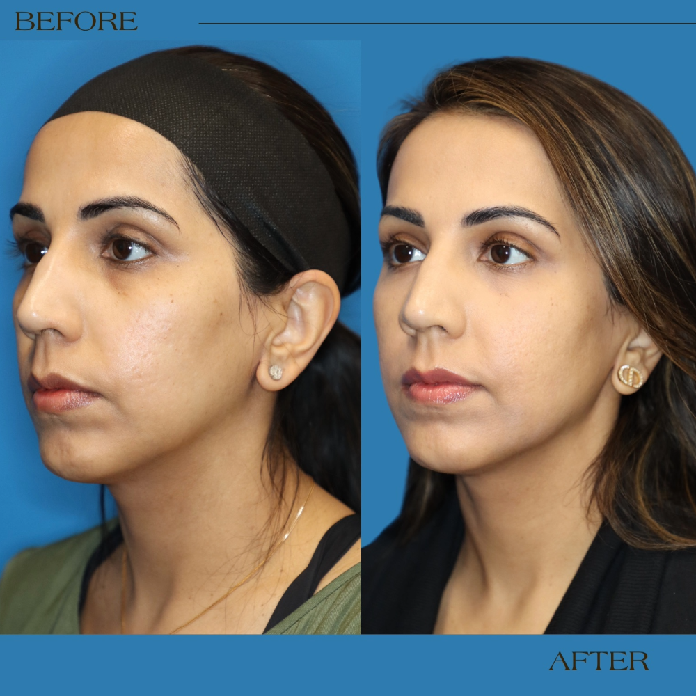 before and after MIRIA laser