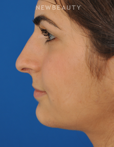 Dr. Edward Kwak - Rhinoplasty - Before