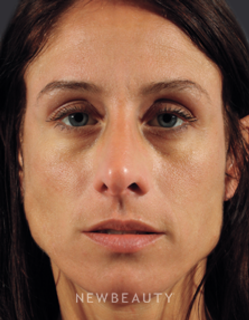 Dr. Marina Peredo Injectables & Fillers - Before