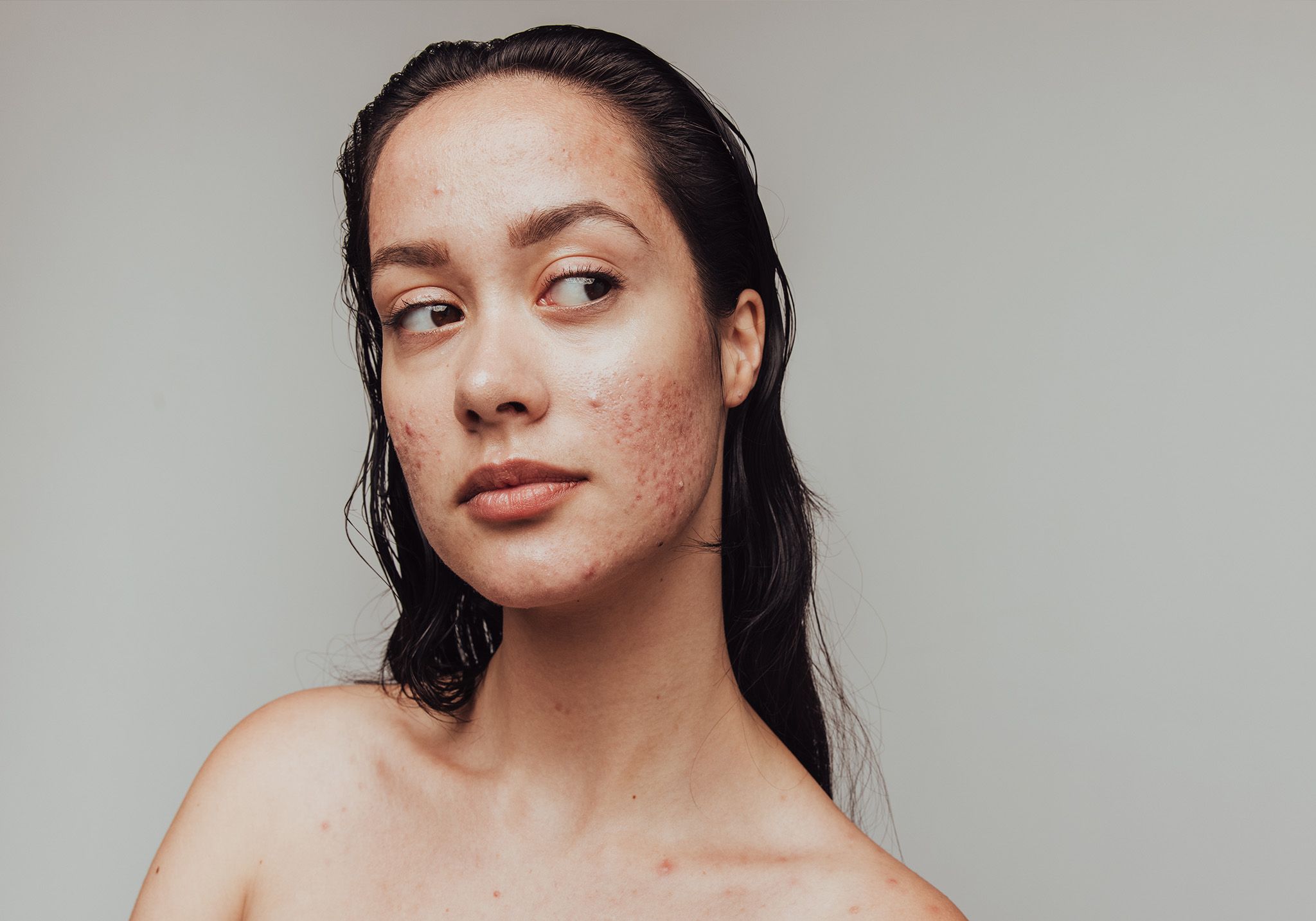 Break Free from Breakouts: Meet AviClear, the Latest in Acne Treatment