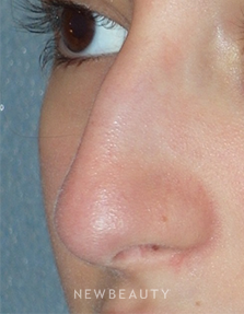 Dr. Min Ahn - Rhinoplasty - Before