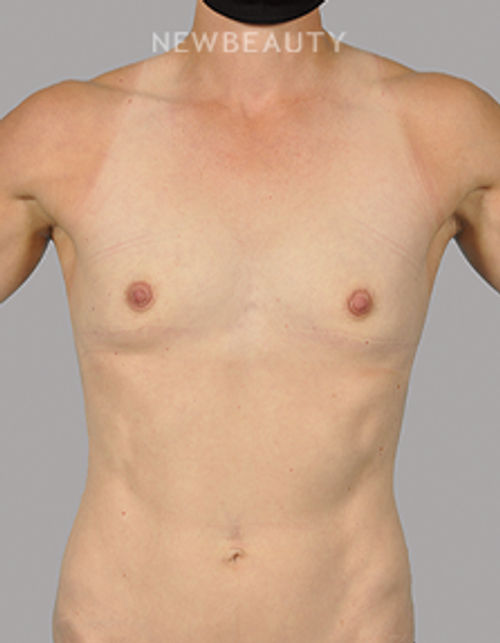 Dr. David Alfonso - Volume Boost - 20902719 - Before