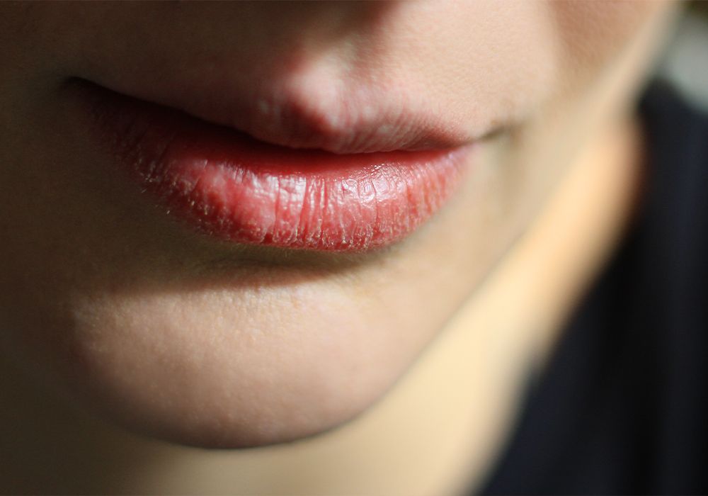 I’m On Accutane and These 4 Products Saved My Dry, Chapped Lips