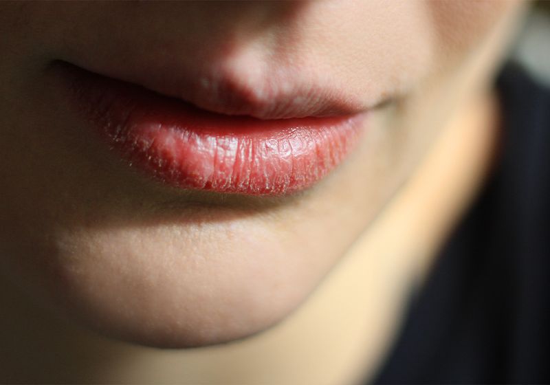 I’m On Accutane and These 4 Products Saved My Dry, Chapped Lips