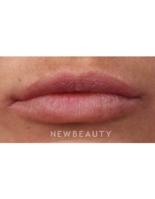 Dr. Kathleen Behr - Lip Filler - After